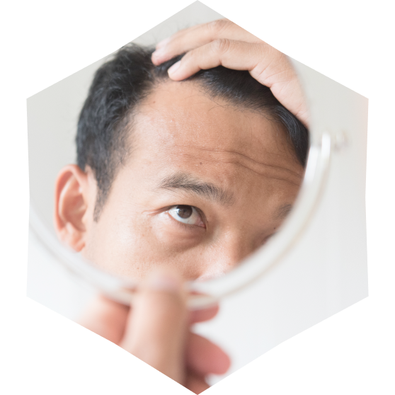 抜け毛に悩む男性